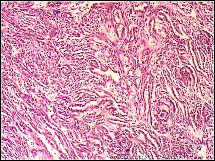 左肾占位--粘液样小管和梭形细胞癌（mucinous tubular and spindle cell carcinoma）图3