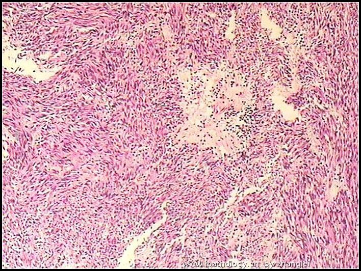 左肾占位--粘液样小管和梭形细胞癌（mucinous tubular and spindle cell carcinoma）图4