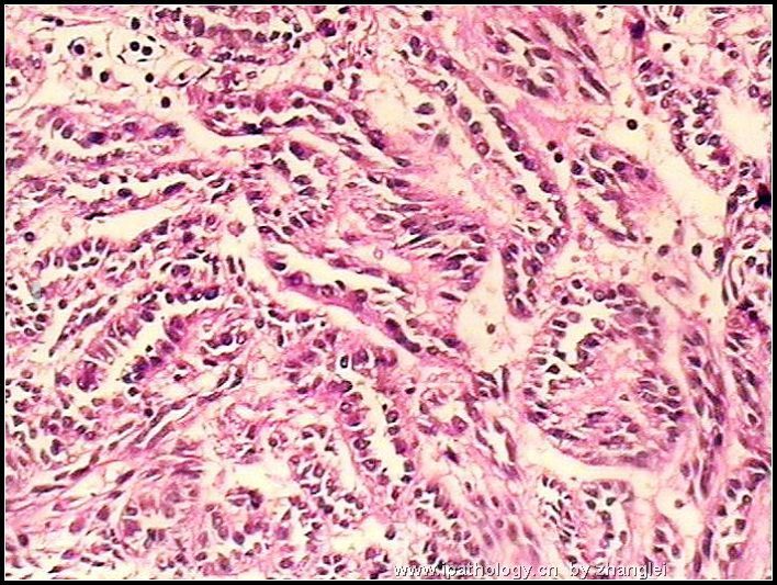 左肾占位--粘液样小管和梭形细胞癌（mucinous tubular and spindle cell carcinoma）图5