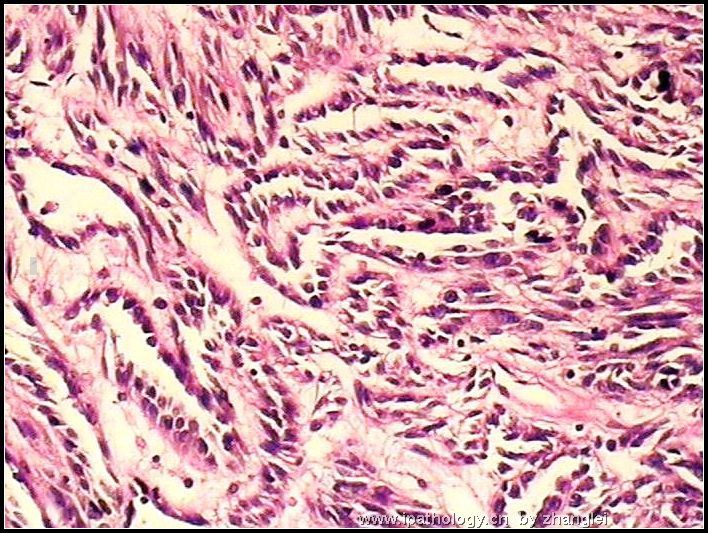 左肾占位--粘液样小管和梭形细胞癌（mucinous tubular and spindle cell carcinoma）图6
