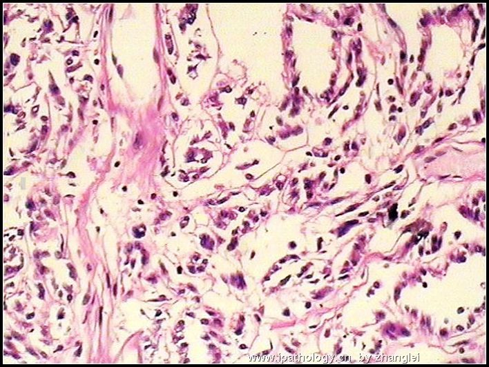 左肾占位--粘液样小管和梭形细胞癌（mucinous tubular and spindle cell carcinoma）图7