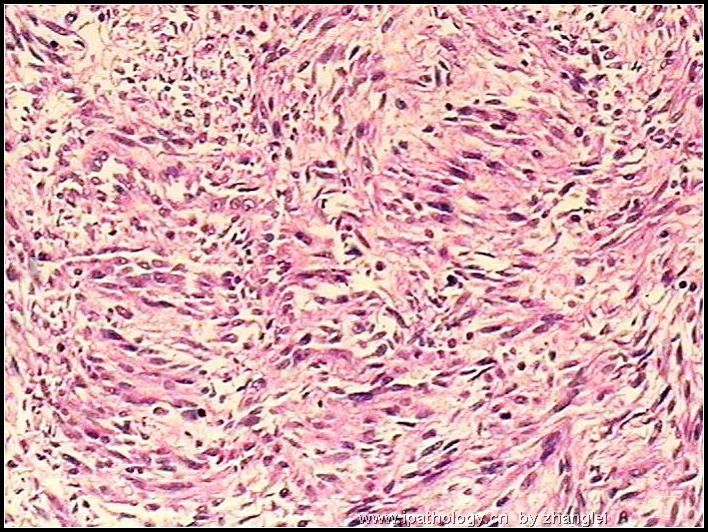 左肾占位--粘液样小管和梭形细胞癌（mucinous tubular and spindle cell carcinoma）图8