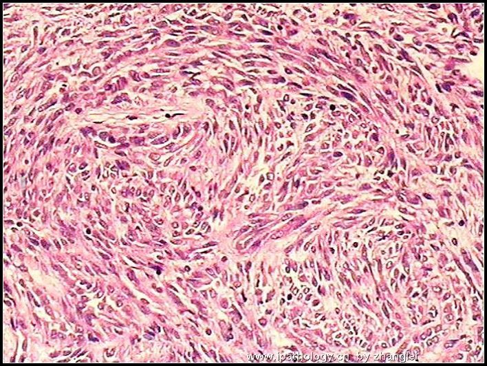 左肾占位--粘液样小管和梭形细胞癌（mucinous tubular and spindle cell carcinoma）图9