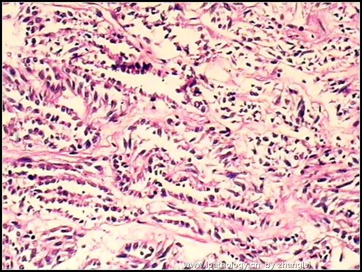 左肾占位--粘液样小管和梭形细胞癌（mucinous tubular and spindle cell carcinoma）图10