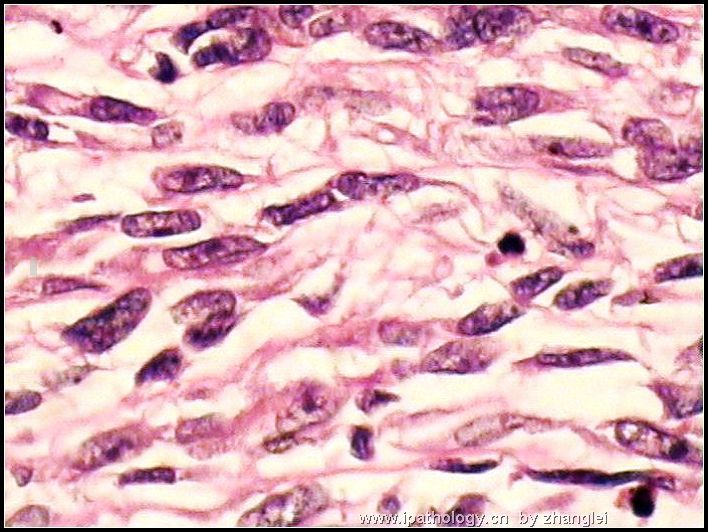 左肾占位--粘液样小管和梭形细胞癌（mucinous tubular and spindle cell carcinoma）图11