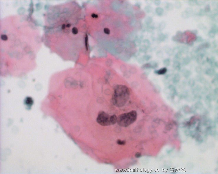 宫颈细胞学(六）图2