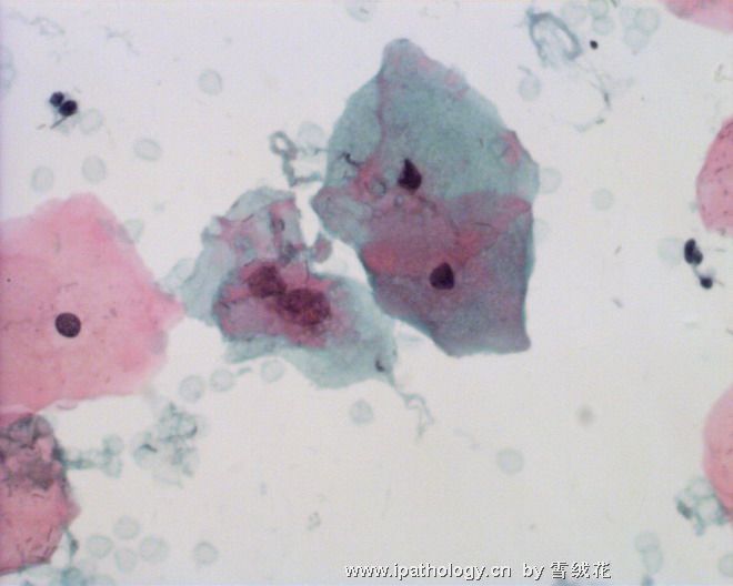 宫颈细胞学(六）图5