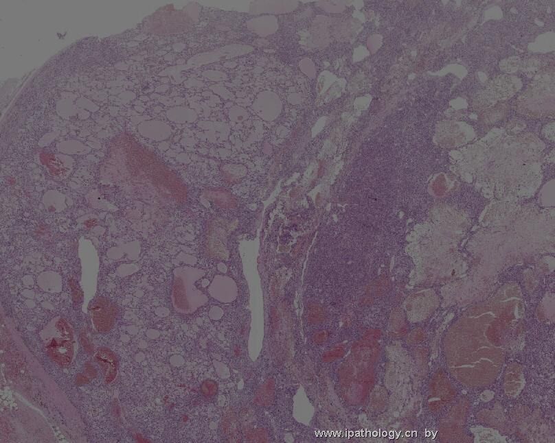 颈背部肿瘤(Atypical Fibroblastic Neoplasm with Pseudoangiomatous…)图1