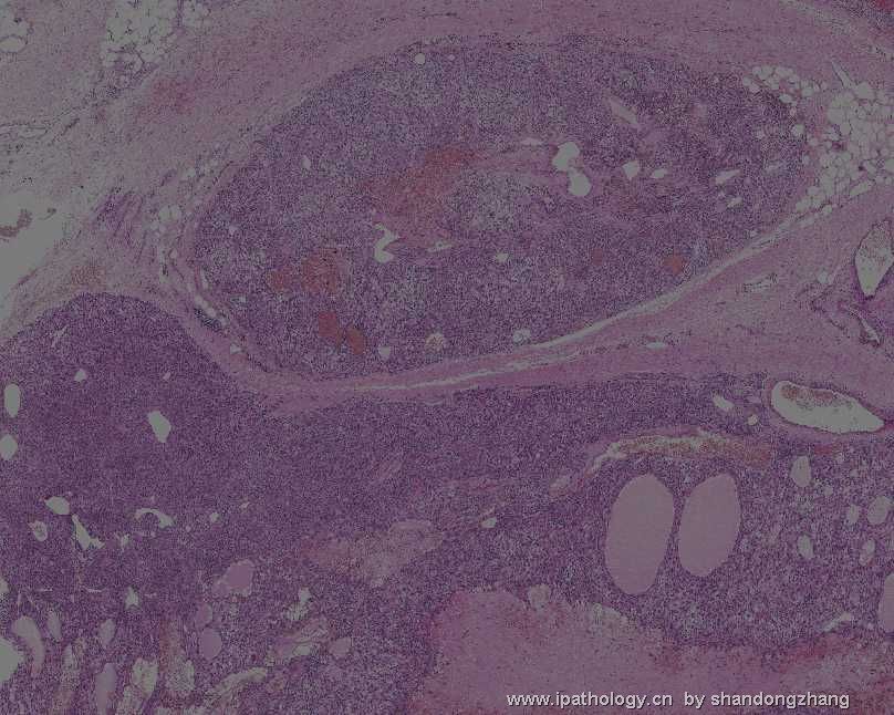 颈背部肿瘤(Atypical Fibroblastic Neoplasm with Pseudoangiomatous…)图2