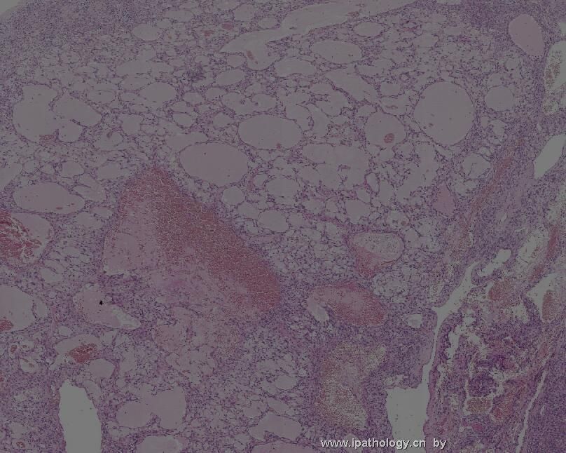 颈背部肿瘤(Atypical Fibroblastic Neoplasm with Pseudoangiomatous…)图3