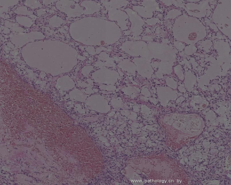颈背部肿瘤(Atypical Fibroblastic Neoplasm with Pseudoangiomatous…)图4