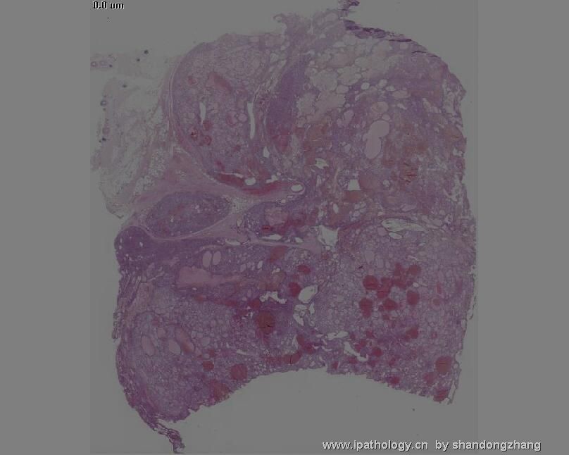 颈背部肿瘤(Atypical Fibroblastic Neoplasm with Pseudoangiomatous…)图5