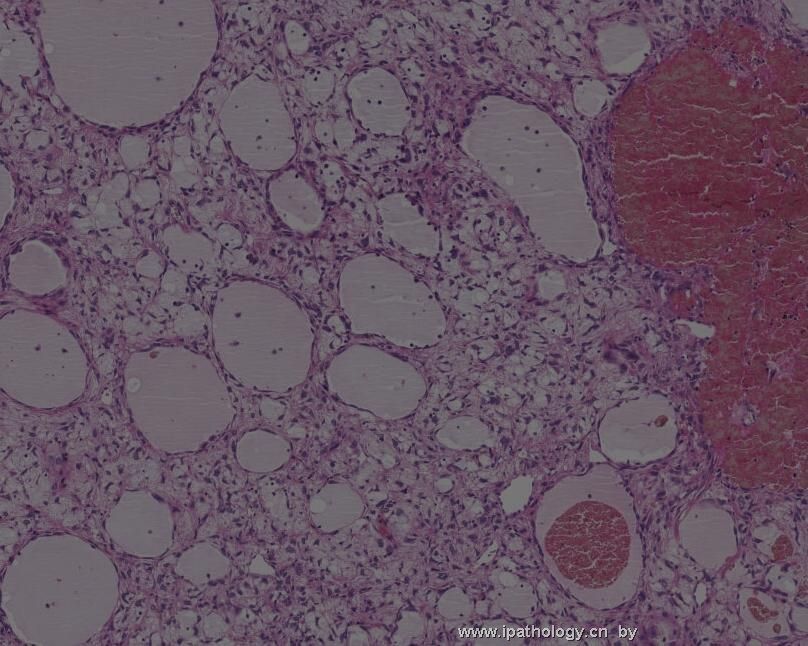 颈背部肿瘤(Atypical Fibroblastic Neoplasm with Pseudoangiomatous…)图6