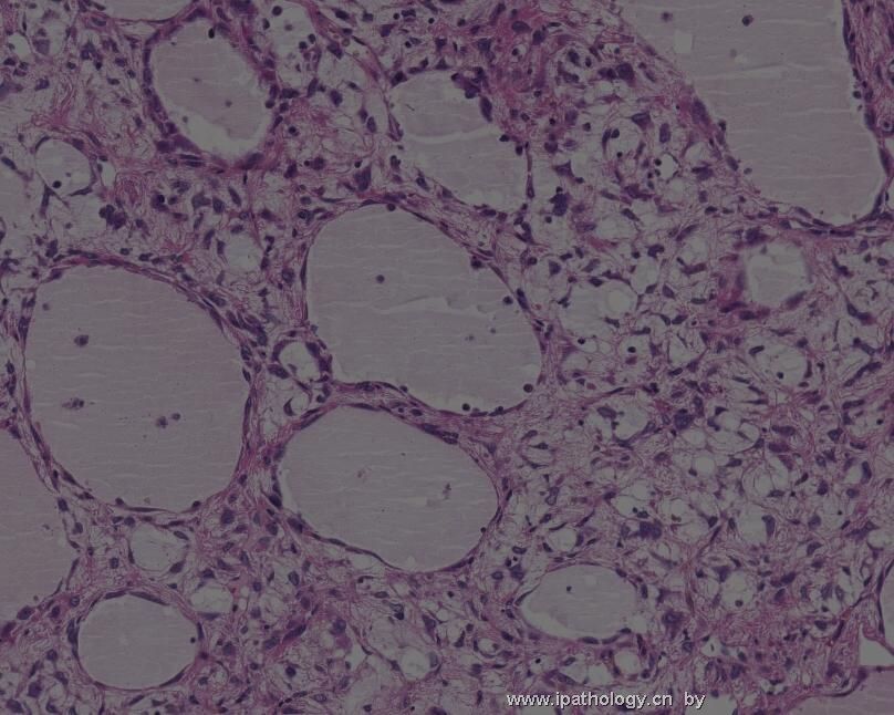 颈背部肿瘤(Atypical Fibroblastic Neoplasm with Pseudoangiomatous…)图7