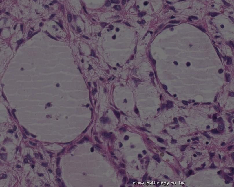 颈背部肿瘤(Atypical Fibroblastic Neoplasm with Pseudoangiomatous…)图8