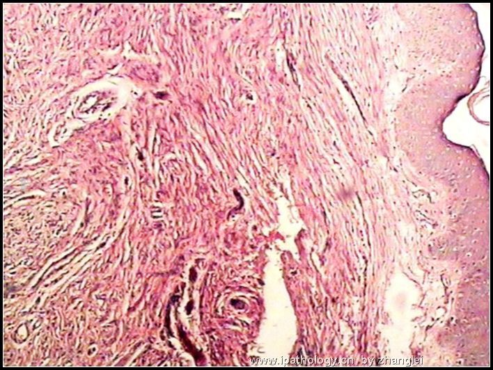 颌下皮肤肿块--神经纤维瘤图1