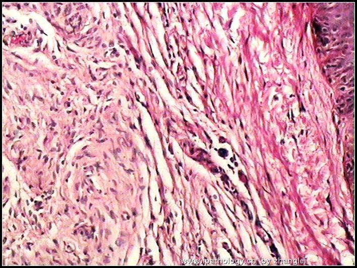 颌下皮肤肿块--神经纤维瘤图4