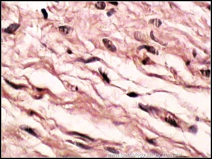 颌下皮肤肿块--神经纤维瘤图10