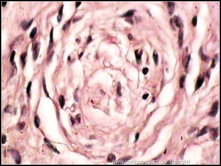 颌下皮肤肿块--神经纤维瘤图11