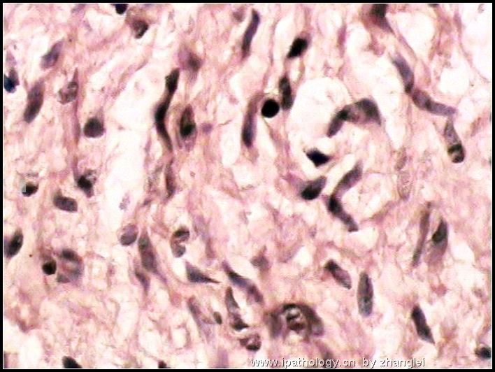颌下皮肤肿块--神经纤维瘤图12