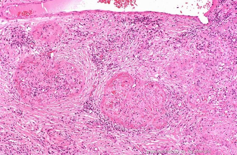 （转贴）脾脏肿瘤--脾脏红髓硬化性结节性转化（Sclerosing nodular transformation of splenic red pulp）图4