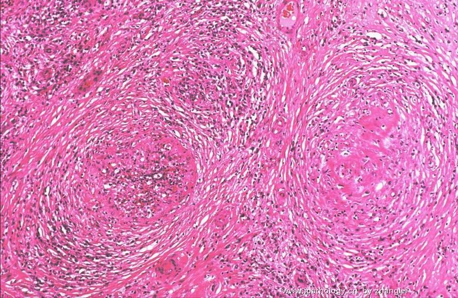 （转贴）脾脏肿瘤--脾脏红髓硬化性结节性转化（Sclerosing nodular transformation of splenic red pulp）图5