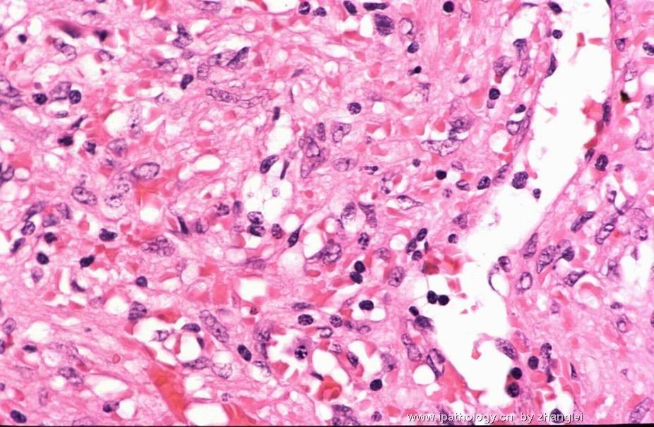 （转贴）脾脏肿瘤--脾脏红髓硬化性结节性转化（Sclerosing nodular transformation of splenic red pulp）图9