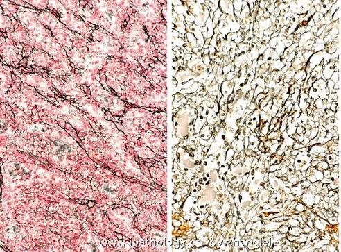 （转贴）脾脏肿瘤--脾脏红髓硬化性结节性转化（Sclerosing nodular transformation of splenic red pulp）图11