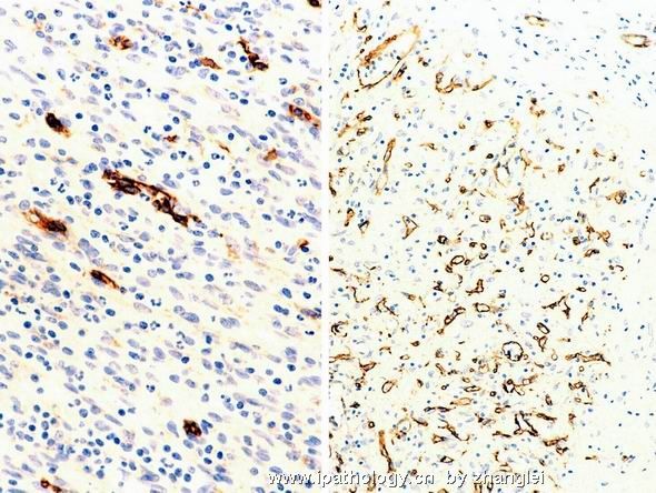 （转贴）脾脏肿瘤--脾脏红髓硬化性结节性转化（Sclerosing nodular transformation of splenic red pulp）图12