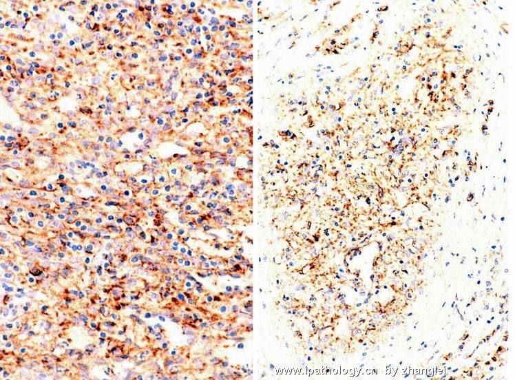 （转贴）脾脏肿瘤--脾脏红髓硬化性结节性转化（Sclerosing nodular transformation of splenic red pulp）图13