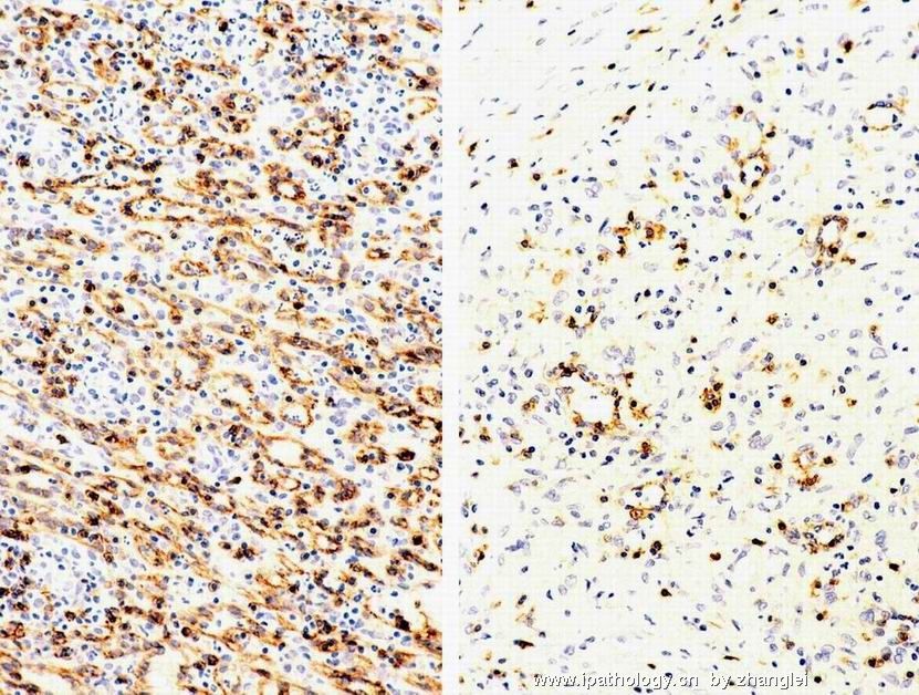 （转贴）脾脏肿瘤--脾脏红髓硬化性结节性转化（Sclerosing nodular transformation of splenic red pulp）图14