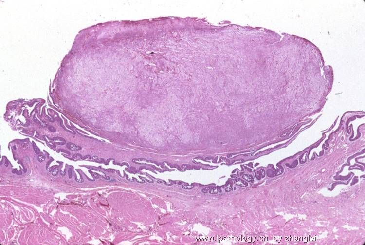 （转贴）前列腺结节－－炎性肌纤维母细胞瘤图1