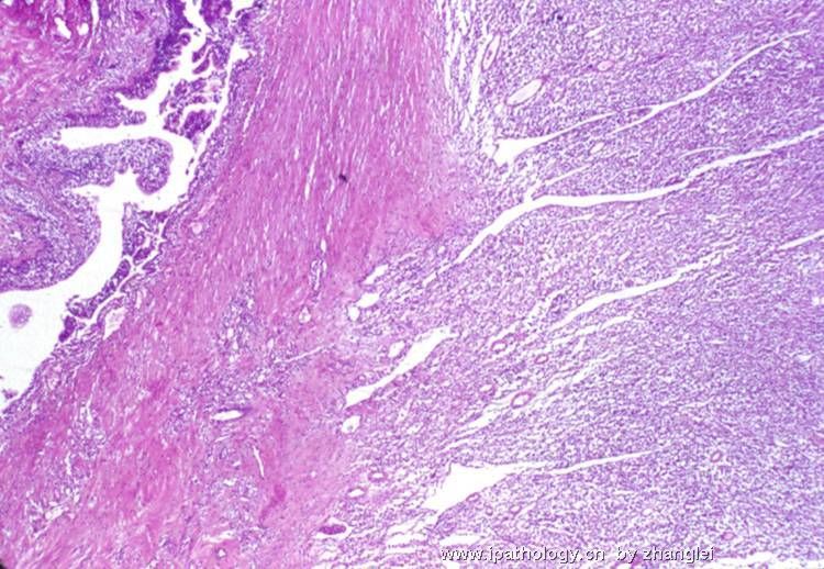 （转贴）前列腺结节－－炎性肌纤维母细胞瘤图2