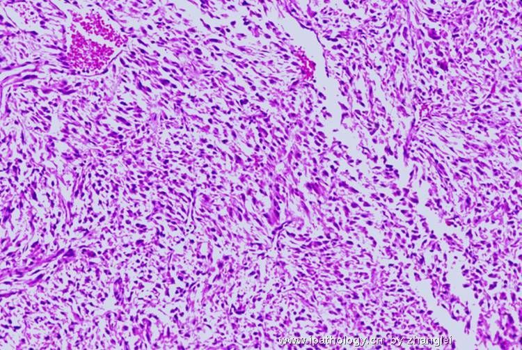（转贴）前列腺结节－－炎性肌纤维母细胞瘤图3