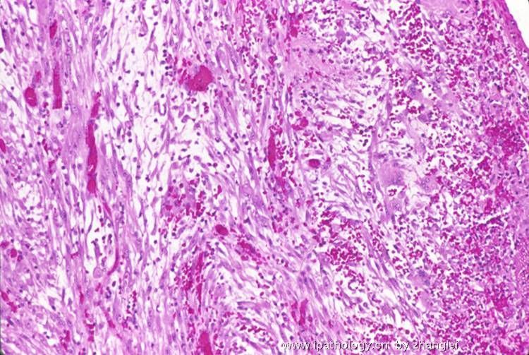 （转贴）前列腺结节－－炎性肌纤维母细胞瘤图5