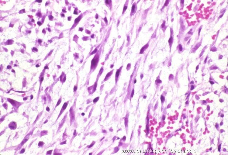 （转贴）前列腺结节－－炎性肌纤维母细胞瘤图6