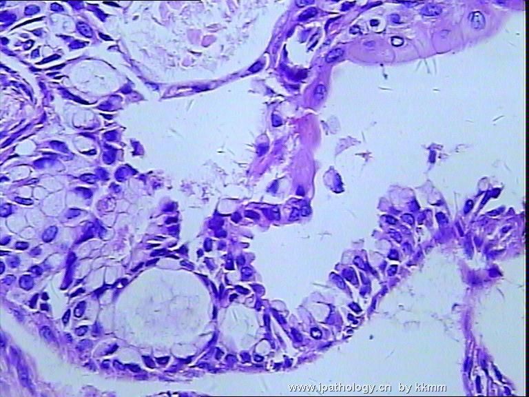 左乳腺肿瘤（P070607）图16