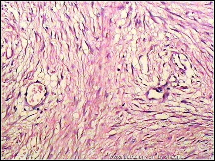 回盲部肠系膜肿块－－侵袭性纤维瘤病图3
