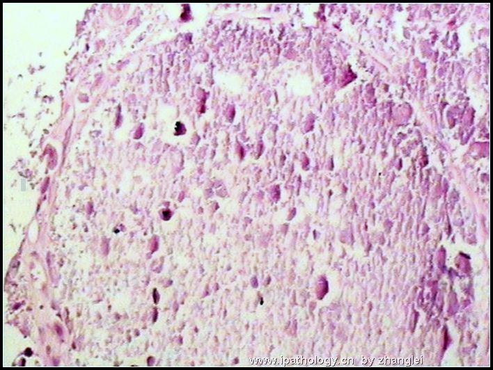 右臀部肿块－－肿瘤性钙质沉着症图2