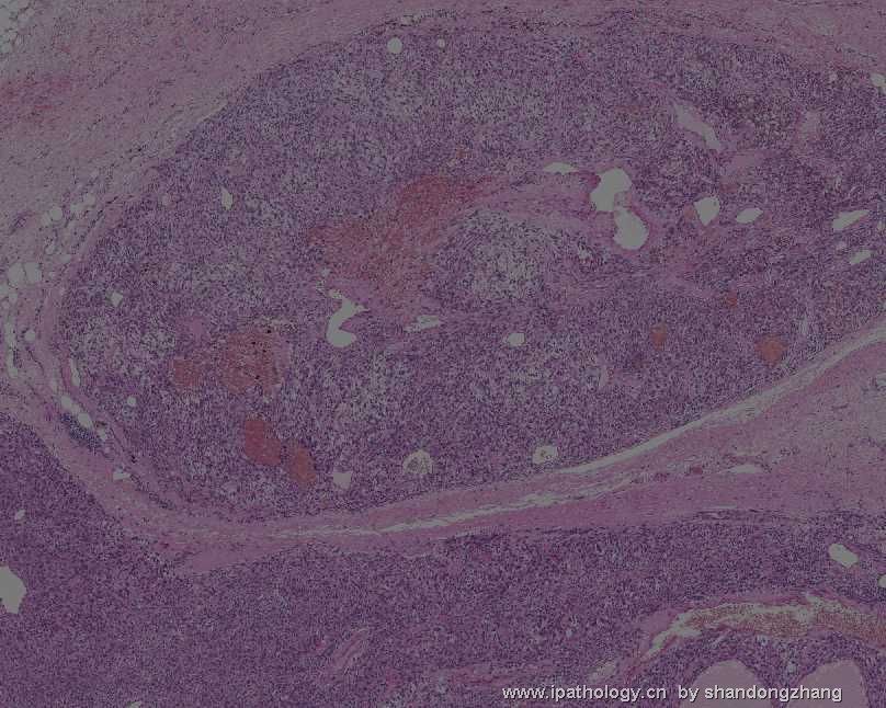 颈背部肿瘤(Atypical Fibroblastic Neoplasm with Pseudoangiomatous…)图10