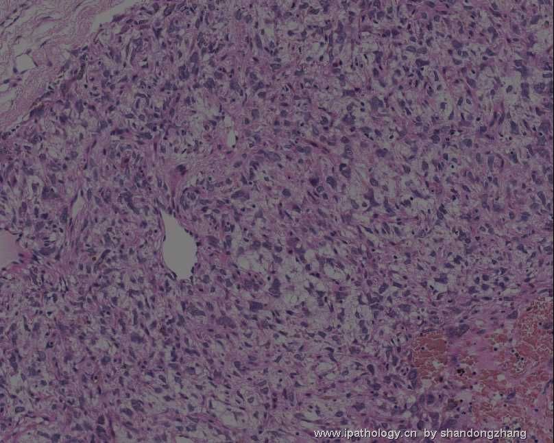 颈背部肿瘤(Atypical Fibroblastic Neoplasm with Pseudoangiomatous…)图11