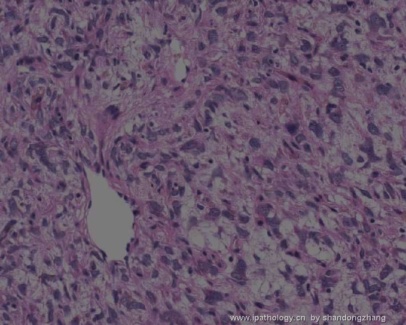颈背部肿瘤(Atypical Fibroblastic Neoplasm with Pseudoangiomatous…)图12