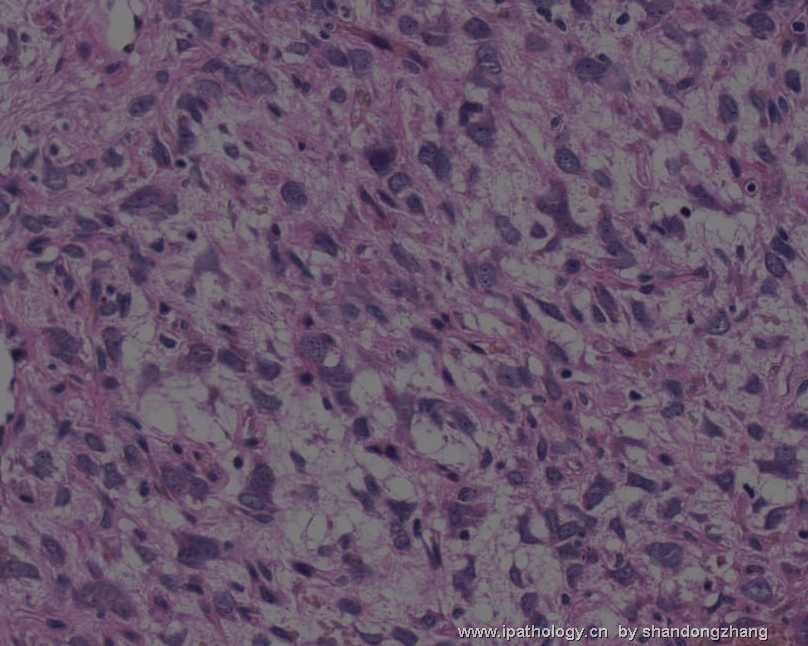 颈背部肿瘤(Atypical Fibroblastic Neoplasm with Pseudoangiomatous…)图13