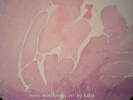 子宫病变-腺肉瘤图1