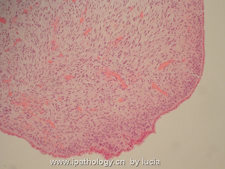 子宫病变-腺肉瘤图3