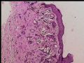 乳头下肿块－浸润性导管癌图1