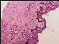 乳头下肿块－浸润性导管癌图2