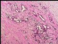 乳头下肿块－浸润性导管癌图6