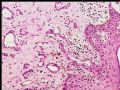 乳头下肿块－浸润性导管癌图7