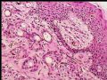 乳头下肿块－浸润性导管癌图8